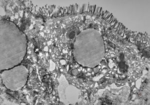 celiakia celiakia